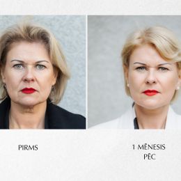 Sejas plastiskā operācija. Pacienta pieredzes stāsts