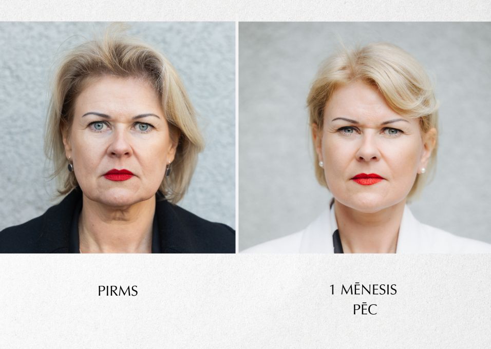 Sejas plastiskā operācija. Pacienta pieredzes stāsts