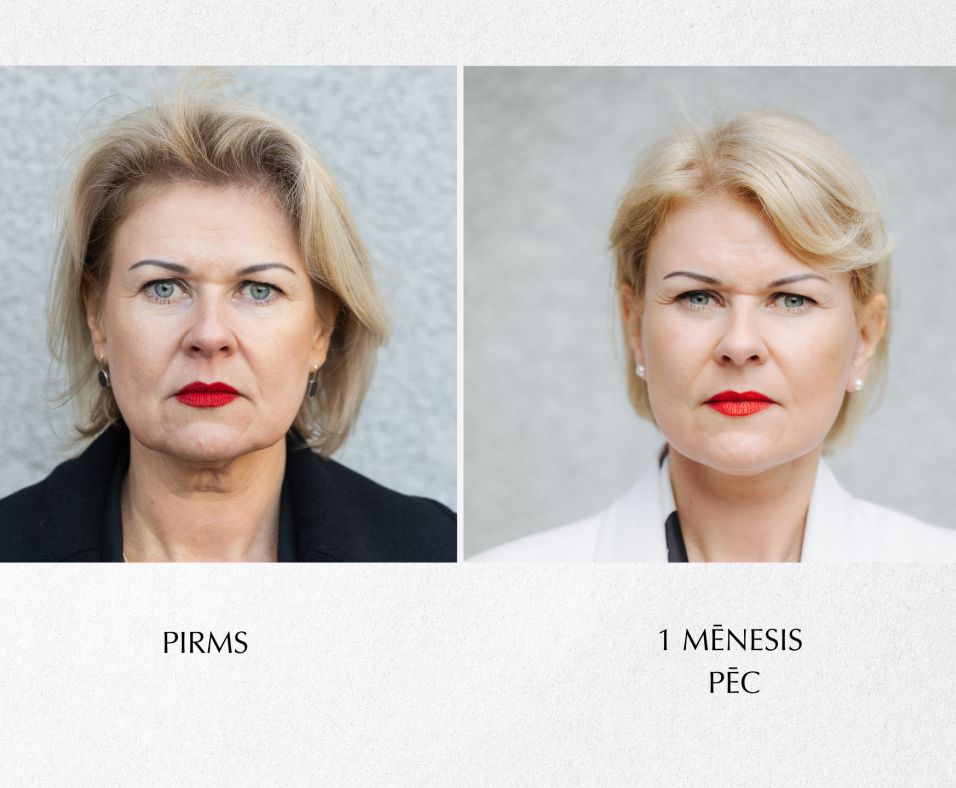 Sejas plastiskā operācija. Pacienta pieredzes stāsts