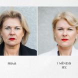 Sejas plastiskā operācija. Pacienta pieredzes stāsts