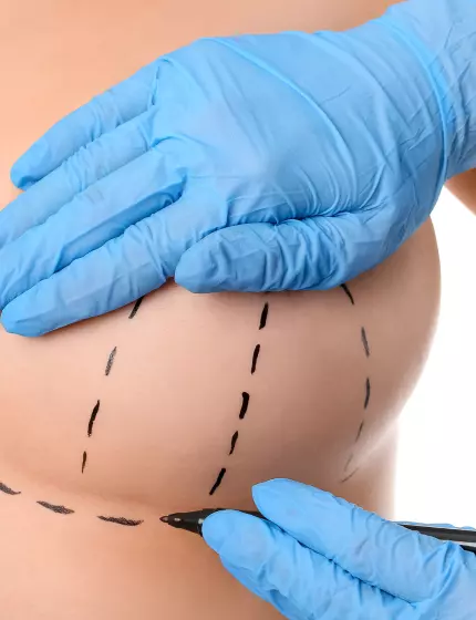 Body plastic surgery