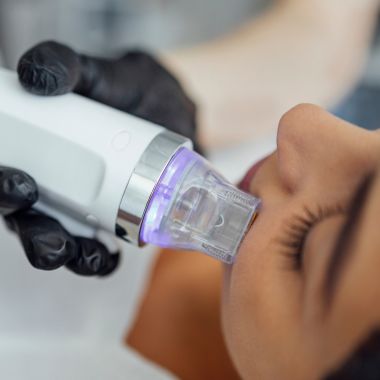 Fractional radiofrequency procedure (Secret RF)
