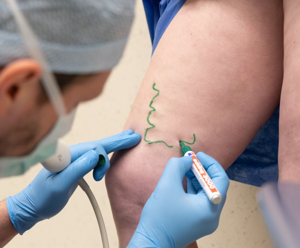 What is sclerotherapy and how effective is this procedure?  