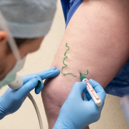 What is sclerotherapy and how effective is this procedure?  