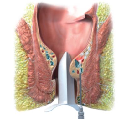 LHP surgery