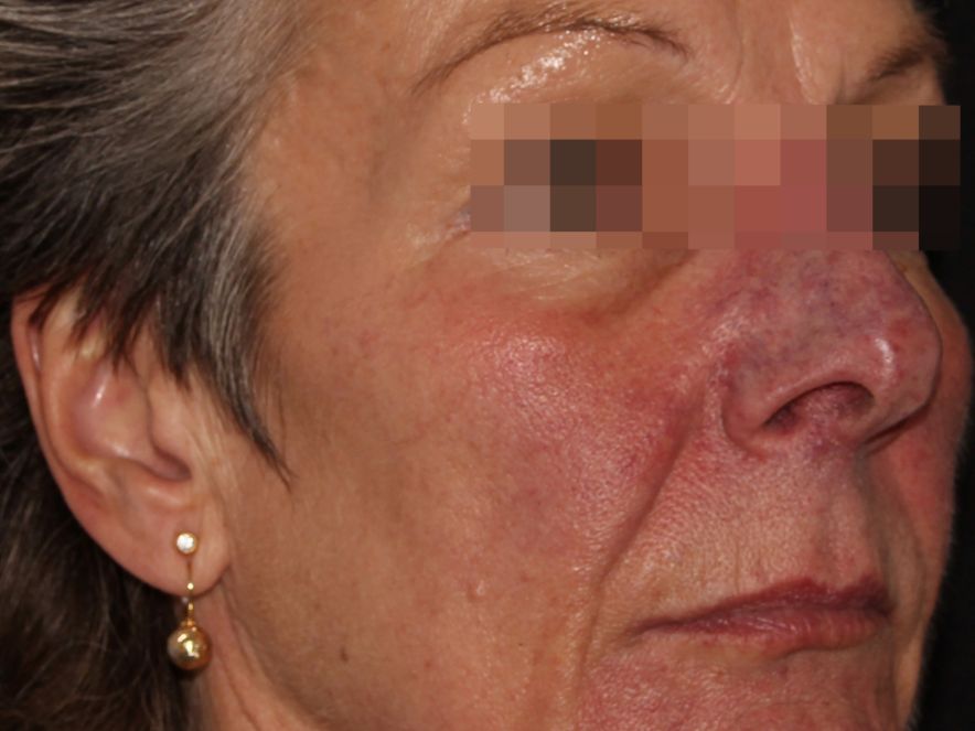 Pirms deguna zonas apstrādes