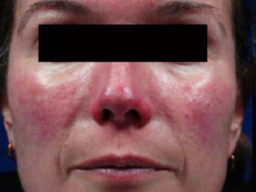 Pacientes sejas āda (rozācija)