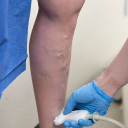 Second opinion from a phlebologist