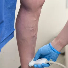 Second opinion from a phlebologist