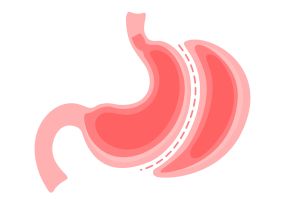 gastric sleeve